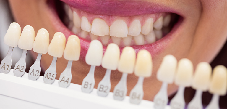 Teeth-whitening01