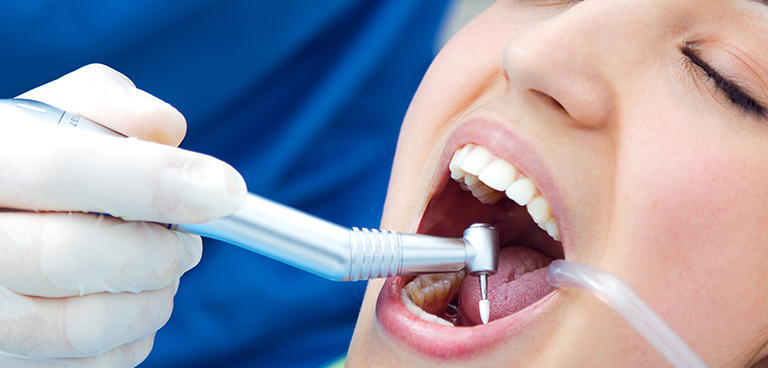 Tooth-fillings