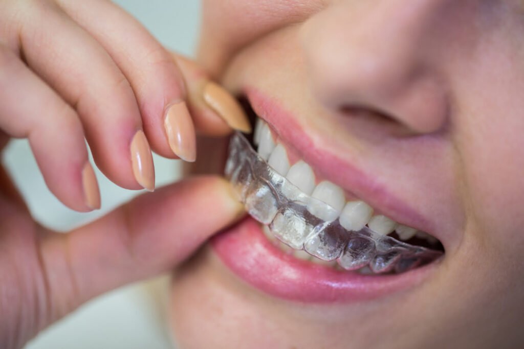 Invisalign in Vadodara
