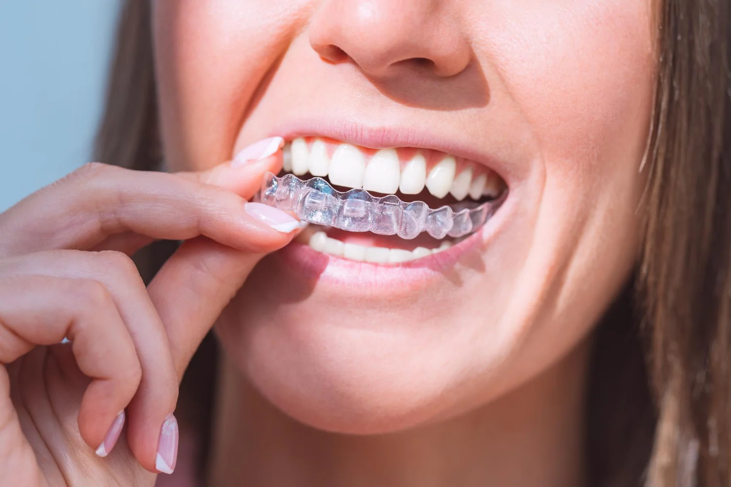 Invisalign-in-vadodara
