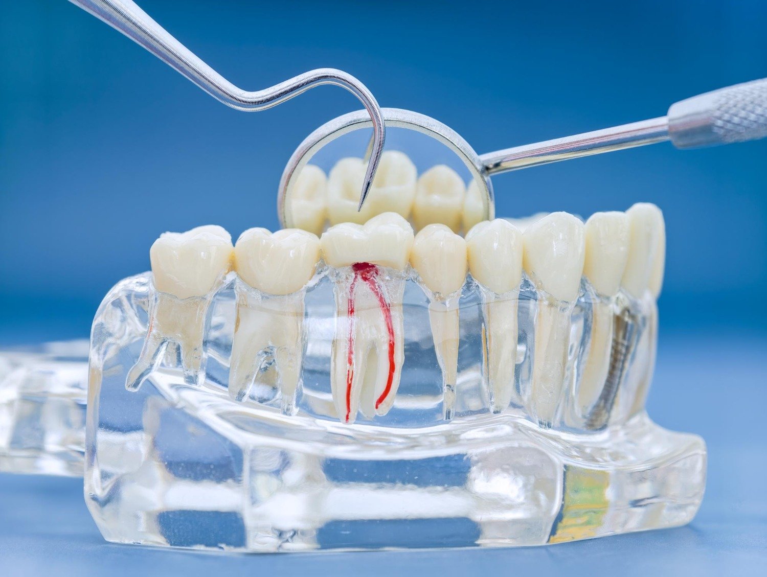 Root Canal Treatment in Vadodara: Everything You Need to Know About Saving a Natural Tooth