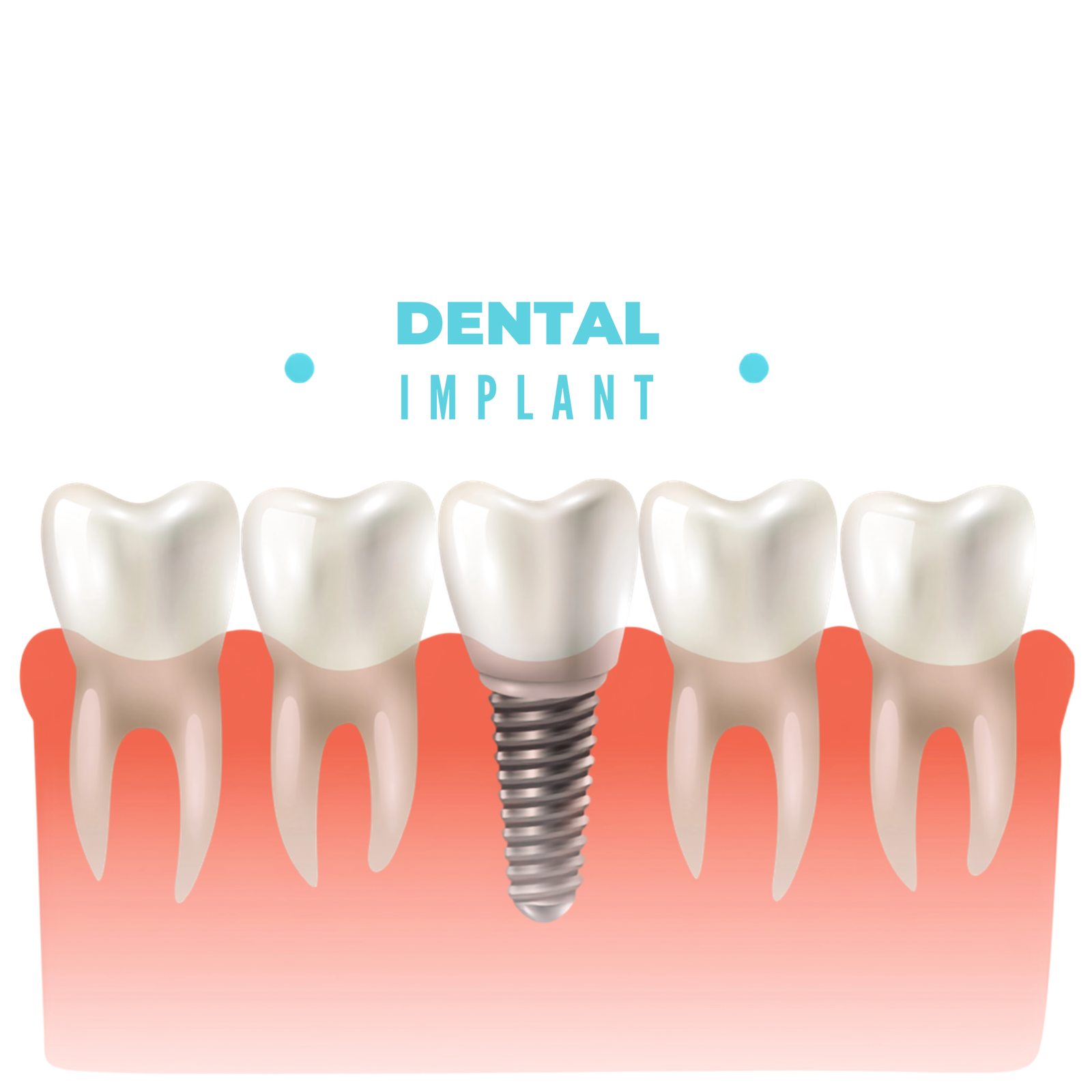 Why Dental Implants Are a Trusted Solution for Missing Teeth in Vadodara