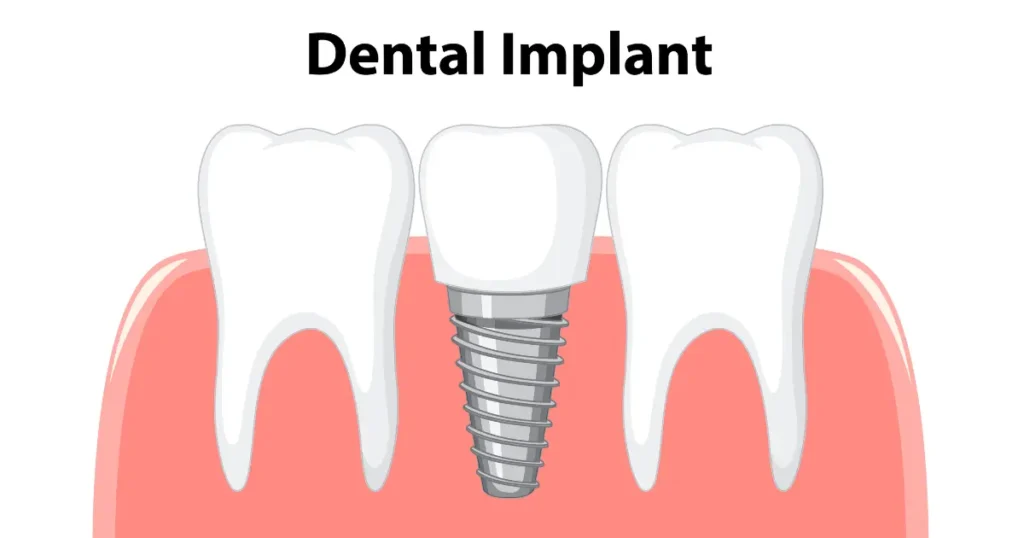 When Is a Dental Implant in Bhayli a Better Choice Than Other Tooth Replacement Options